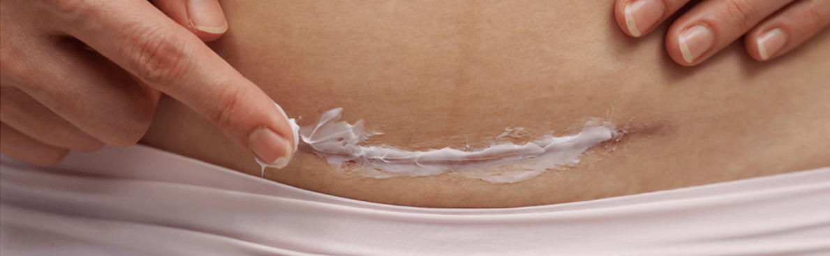 Császármetszés utáni felépülés és hegkezelés – szakértői interjú Bartos Ritával